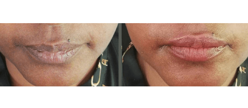 micropigmentación de labios en pinto
